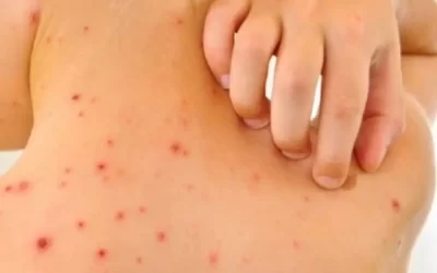 En Veracruz no hay reporte de casos de sarampión, afirma Secretaría de Salud